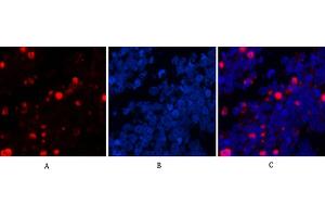 Immunofluorescence analysis of human lung cancer tissue. (Caspase 3 p17 (AA 100-180), (Cleaved-Asp175) anticorps)