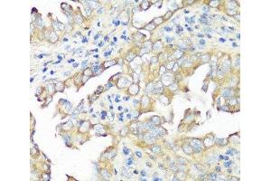 Immunohistochemistry of paraffin-embedded Human lung cancer using EIF3B Polyclonal Antibody at dilution of 1:100 (40x lens). (EIF3B anticorps)