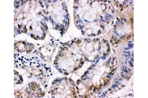 Anti-MCM5 antibody, IHC(P) IHC(P): Human Intestinal Cancer Tissue (MCM5 anticorps  (C-Term))