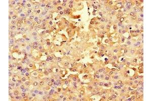 Immunohistochemistry of paraffin-embedded human breast cancer using ABIN7142567 at dilution of 1:100