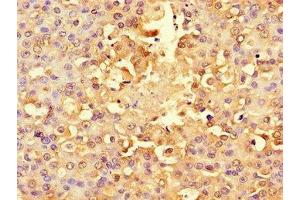 Immunohistochemistry of paraffin-embedded human breast cancer using ABIN7142567 at dilution of 1:100
