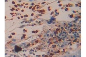 Detection of AZU in Human Stomach cancer Tissue using Polyclonal Antibody to Azurocidin (AZU)