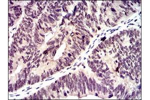 Immunohistochemical analysis of paraffin-embedded rectum cancer tissues using ID2 mouse mAb with DAB staining. (Id2 anticorps  (AA 1-134))