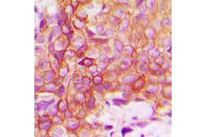Immunohistochemical analysis of CD120a staining in human breast cancer formalin fixed paraffin embedded tissue section.