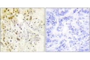 Immunohistochemistry analysis of paraffin-embedded human breast carcinoma tissue, using Cyclin L1 Antibody. (Cyclin L1 anticorps  (AA 461-510))