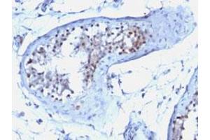 Immunohistochemical staining (Formalin-fixed paraffin-embedded sections) of human testicular carcinoma with CCNB1 monoclonal antibody, clone CCNB1/1098 . (Cyclin B1 anticorps)
