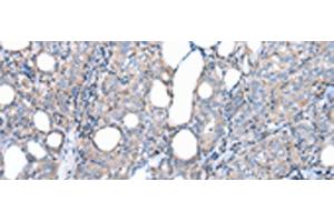 Immunohistochemistry of paraffin-embedded Human thyroid cancer tissue using FKBPL Polyclonal Antibody at dilution of 1:50(x200) (FKBPL anticorps)