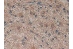 Detection of SDF2 in Human Glioma Tissue using Polyclonal Antibody to Stromal Cell Derived Factor 2 (SDF2)
