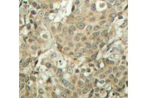 Immunohistochemistry of paraffin-embedded Human breast carcinoma tissue, using Phospho-CFL1(S3) Polyclonal Antibody