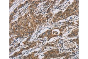 Immunohistochemistry of Human gastric cancer using AGER Polyclonal Antibody at dilution of 1:70 (RAGE anticorps)