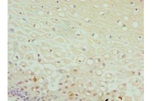 Immunohistochemistry of paraffin-embedded human cervical cancer using ABIN7149983 at dilution of 1:100