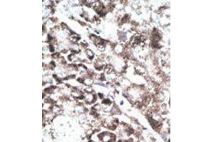 Formalin-fixed and paraffin-embedded human cancer tissue reacted with the primary antibody, which was peroxidase-conjugated to the secondary antibody, followed by DAB staining.