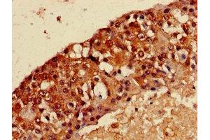 Immunohistochemistry of paraffin-embedded human breast cancer using ABIN7159273 at dilution of 1:100 (MAGEA8 anticorps  (AA 1-270))