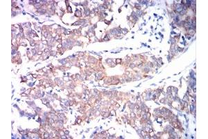 Immunohistochemical analysis of paraffin-embedded cervical cancer tissues using ADAM10 mouse mAb with DAB staining. (ADAM10 anticorps)