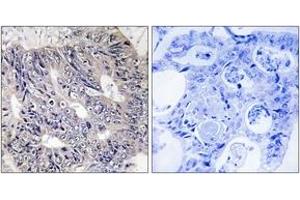 Immunohistochemistry analysis of paraffin-embedded human colon carcinoma tissue, using ES8L1 Antibody. (EPS8-Like 1 anticorps  (AA 411-460))