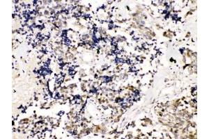 IHC testing of FFPE human lung cancer tissue with TRF2 antibody at 1ug/ml. (TRF2 anticorps)
