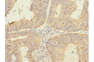 Immunohistochemistry of paraffin-embedded human endometrial cancer using ABIN7166095 at dilution of 1:100