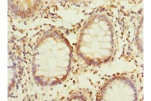 Immunohistochemistry of paraffin-embedded human colon cancer using ABIN7163353 at dilution of 1:100