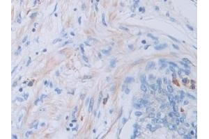 Detection of CTSV in Human Prostate Tissue using Polyclonal Antibody to Cathepsin V (CTSV) (Cathepsin L2 anticorps  (AA 64-334))