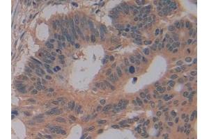 Detection of GSTm4 in Human Colorectal cancer Tissue using Polyclonal Antibody to Glutathione S Transferase Mu 4 (GSTm4)