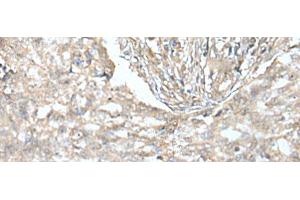 Immunohistochemistry of paraffin-embedded Human lung cancer tissue using VILL Polyclonal Antibody at dilution of 1:65(x200) (VILL anticorps)