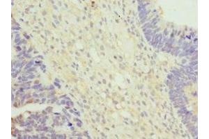 Immunohistochemistry of paraffin-embedded human ovarian cancer using ABIN7175314 at dilution of 1:100