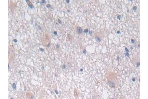 Detection of SEMA3E in Human Glioma Tissue using Polyclonal Antibody to Semaphorin 3E (SEMA3E)