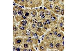 Immunohistochemical analysis of DLD staining in human liver cancer formalin fixed paraffin embedded tissue section. (DLD anticorps)