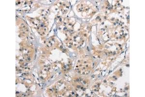 Immunohistochemical analysis of paraffin-embedded Human thyroid cancer tissue using at dilution 1/25. (CTAG1A anticorps  (Internal Region))