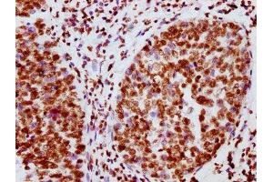 IHC image of ABIN7127703 diluted at 1:100 and staining in paraffin-embedded human cervical cancer performed on a Leica BondTM system.