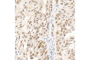 Immunohistochemistry of paraffin-embedded human colon carcinoma using SOCS1 Rabbit mAb (ABIN7270640) at dilution of 1:100 (40x lens). (SOCS1 anticorps)