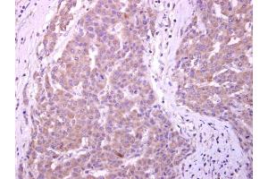 IHC-P Image CYP7B1 antibody [C3], C-term detects CYP7B1 protein at cytoplasm on human liver carcinoma by immunohistochemical analysis.