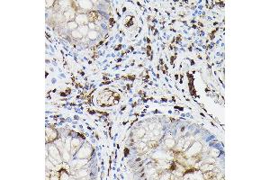 Immunohistochemistry of paraffin-embedded human colon carcinoma using Gelsolin Rabbit pAb (ABIN7267365) at dilution of 1:50 (40x lens). (Gelsolin anticorps  (AA 543-782))