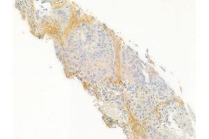 ABIN6260948 and ABIN6266880 at 1/100 staining human lung squamous cell carcinoma by IHC-P.