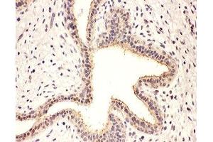 IHC-P: Rab8 antibody testing of human breast cancer tissue (RAB8A anticorps  (C-Term))