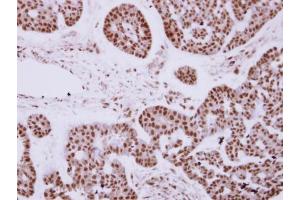IHC-P Image Immunohistochemical analysis of paraffin-embedded human breast cancer, using ZNF148 antibody [N1N2], N-term, antibody at 1:250 dilution.