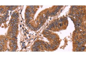 Immunohistochemistry of paraffin-embedded Human colon cancer using ERP29 Polyclonal Antibody at dilution of 1:40 (ERP29 anticorps)