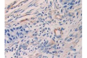 Detection of ENA78 in Human Colorectal cancer Tissue using Polyclonal Antibody to Epithelial Neutrophil Activating Peptide 78 (ENA78)