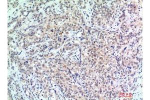 Immunohistochemistry (IHC) analysis of paraffin-embedded Human Breast Cancer, antibody was diluted at 1:200. (p300 anticorps)