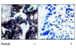 Immunohistochemical analysis of paraffin-embedded human breast carcinoma tissue, using RPS6KB1 (phospho S424) polyclonal antibody .