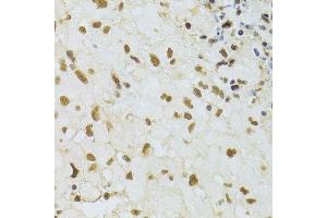 Immunohistochemistry of paraffin-embedded human brain cancer using DDB1 Antibody. (DDB1 anticorps)