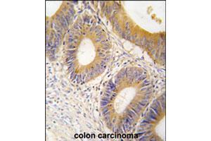 Formalin-fixed and paraffin-embedded human colon carcinoma tissue reacted with ALDOC polyclonal antibody  , which was peroxidase-conjugated to the secondary antibody, followed by DAB staining. (ALDOC anticorps  (C-Term))