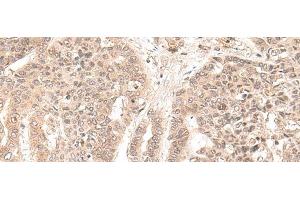 Immunohistochemistry of paraffin-embedded Human liver cancer tissue using EXOSC9 Polyclonal Antibody at dilution of 1:35(x200) (EXOSC9 anticorps)