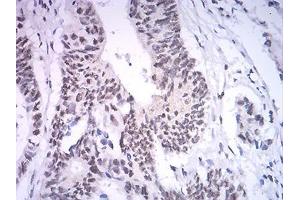Immunohistochemical analysis of paraffin-embedded rectum cancer tissues using ASH2L mouse mAb with DAB staining.