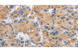 Immunohistochemistry of paraffin-embedded Human liver cancer tissue using DKK2 Polyclonal Antibody at dilution 1:60 (DKK2 anticorps)