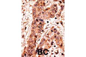 Formalin-fixed and paraffin-embedded human breast cancer tissue reacted with GUCY1A2 polyclonal antibody  , which was peroxidase-conjugated to the secondary antibody, followed by AEC staining. (GUCY1A2 anticorps  (C-Term))