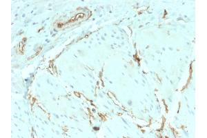Formalin-fixed, paraffin-embedded human Breast Carcinoma stained with CD34 Recombinant Rabbit Monoclonal Antibody (HPCA1/2598R).