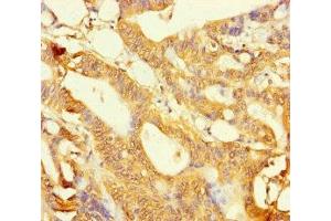 Immunohistochemistry of paraffin-embedded human colon cancer using ABIN7158821 at dilution of 1:100 (LYG2 anticorps  (AA 20-212))