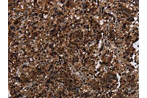 The image on the left is immunohistochemistry of paraffin-embedded Human liver cancer tissue using ABIN7191356(MAGEE1 Antibody) at dilution 1/30, on the right is treated with synthetic peptide. (MAGEE1 anticorps)