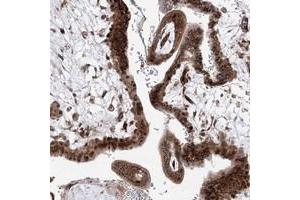 Immunohistochemical staining of human placenta with ARHGAP31 polyclonal antibody  shows cytoplasmic and nuclear positivity in trophoblastic cells at 1:200-1:500 dilution.